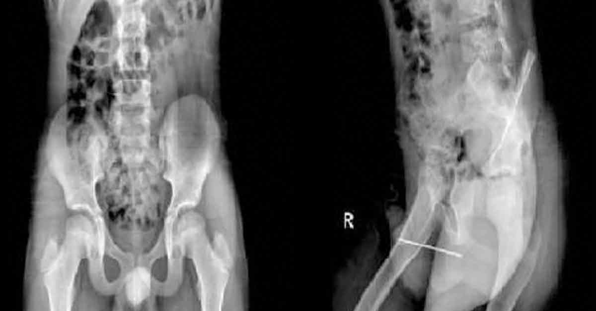 伊朗一名10岁男童把长8.7公分的缝针插进生殖器，图为X光照。
