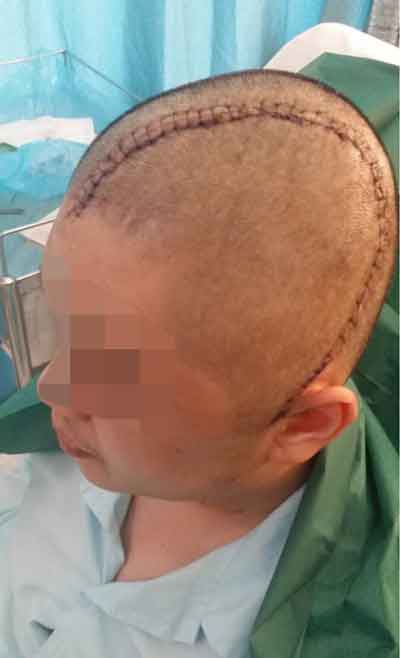 阿达姆手术后，额头至左耳的头顶部位，留下一道长长的疤痕。（档案照）