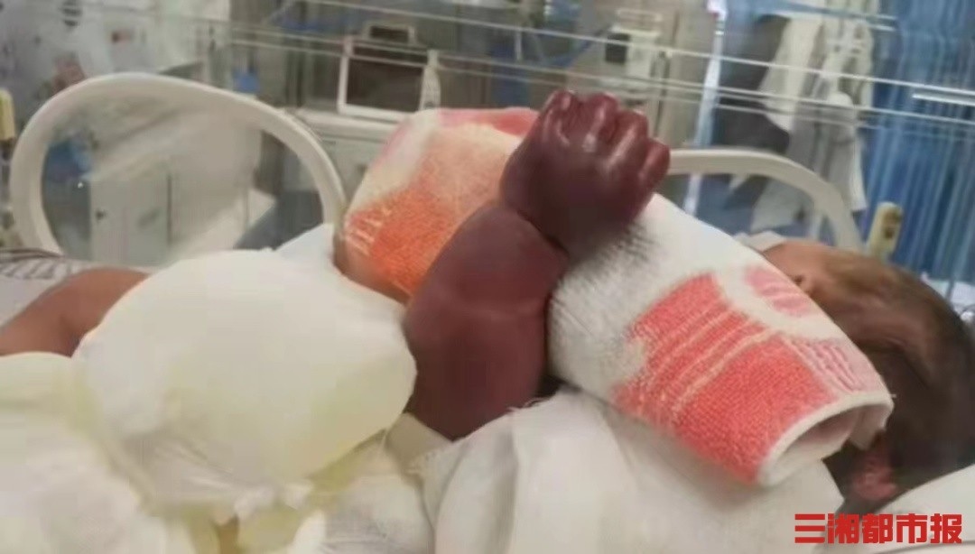 寶寶手臂已經呈黑紫色。