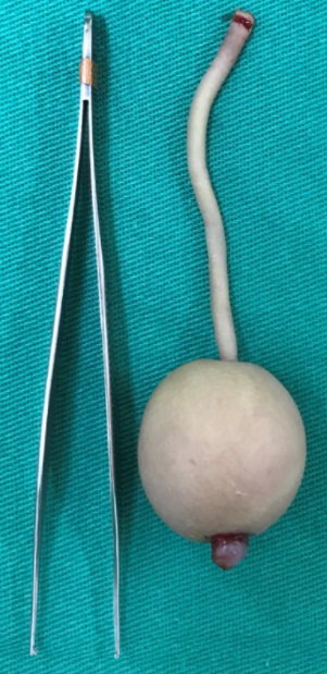 医生动手术切除男婴的尾巴。