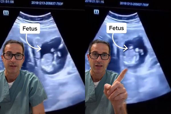 医生在为患者进行超音波扫描后，竟然在肝脏中发现胎儿。