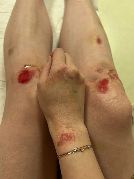 高嘉瑜手脚伤口都还无法结痂，伤口仍然鲜血直流。