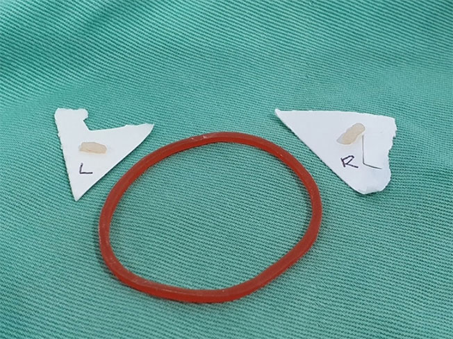 输精管管径仅如橡皮筋般细。图为从进行结扎术男性身上截断的左、右两侧输精管。