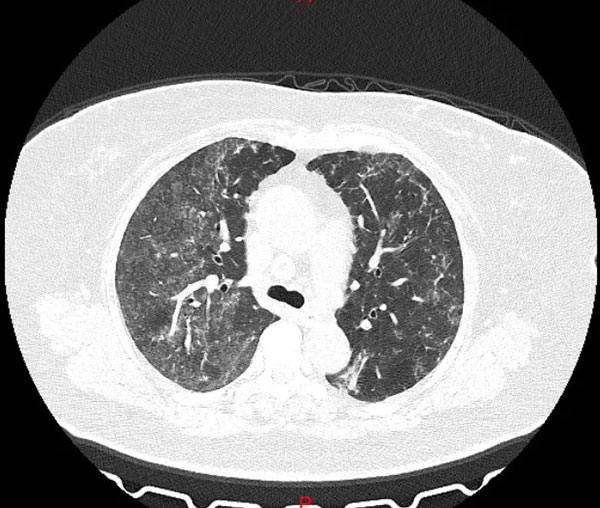 王女士肺部CT