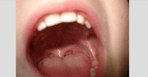 舌头冒斑点误会染性病 女子拖延就医 舌癌扩散