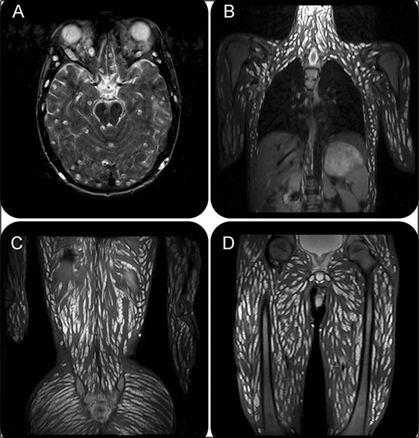 核磁共振照片显示，男子的脑组织、头部、胸腹部、脊椎与四肢，几乎全身都有猪肉绦虫的踪迹。