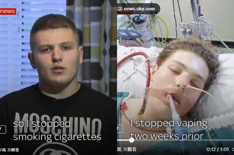 英国少年费舍尔吸了电子烟后，出现肺部衰竭症状。