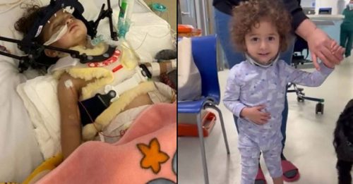 1岁女童车祸  颈椎骨折恐瘫痪  3个月后劫后重生下床走路 　