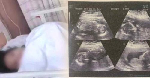 四胎孕妇罕见分娩 2婴隔4天出世 2婴仍留腹中