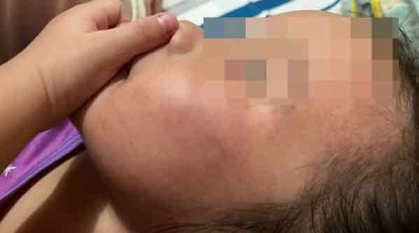 女童被“轻轻”掌掴后，被带去美里医院验伤。