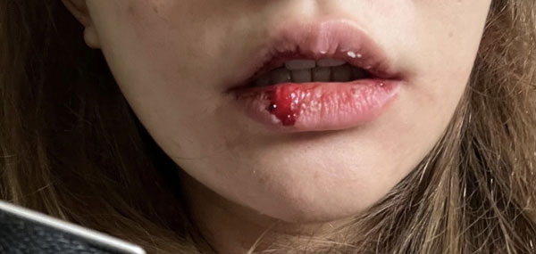 女子被林曜晟打到嘴角红肿流血。（取自台湾《苹果新闻网》）