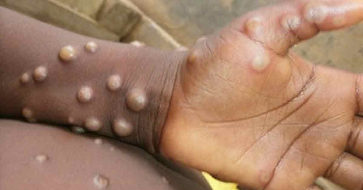 猴痘病毒患者出现的症状。（档案照）