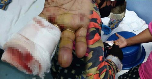 妇女手指被烟花炸伤 金戒指取不出 BOMBA来救援