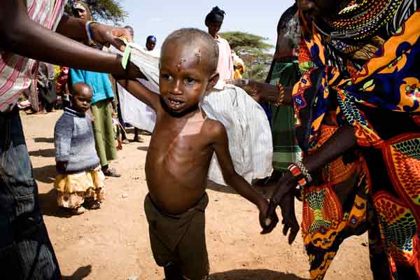 埃塞俄比亚面对饥荒，儿童营养不良。（档案照） 