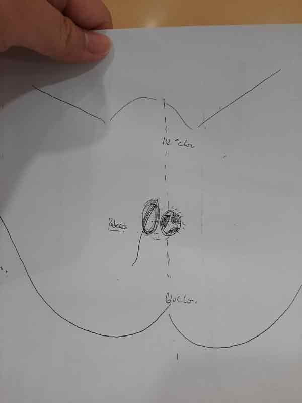 屁股正中为肛门(内痔若干),其左为肛周脓肿。(扎克里绘)