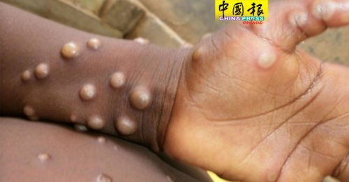 ◤猴痘来袭◢ 猴痘主要传染途径 分析指：是性交！