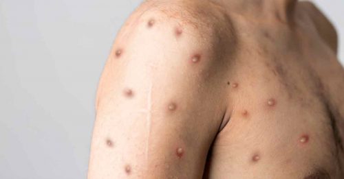世界卫生网络宣布 猴痘为大流行病！