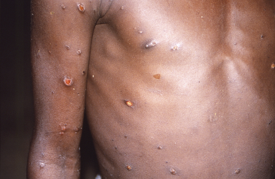 人感染猴痘后可发展为面部和身体大范围皮疹。（美联社）