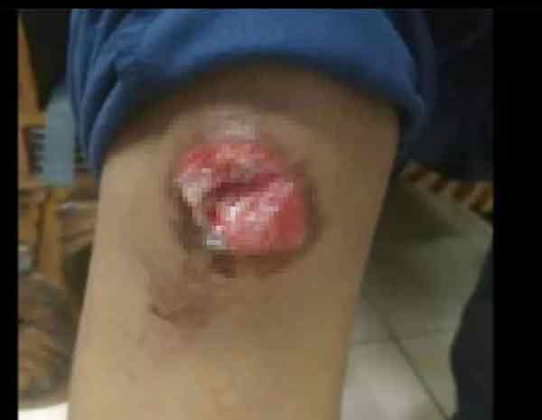 伤者膝盖伤势严重。