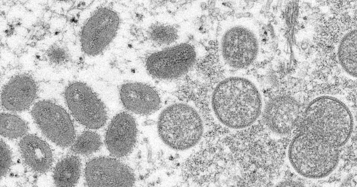 美国发现2种不同的猴痘病毒株。（美联社）