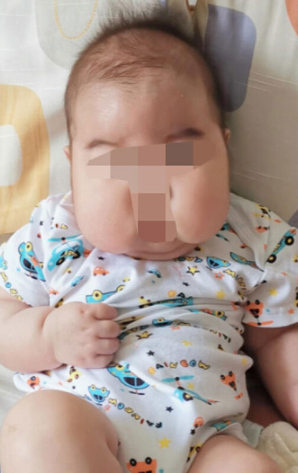 四个月大的男宝宝涂了星星膏后，出现脸肿的情况，家长立即带孩子求医。（受访者提供）
