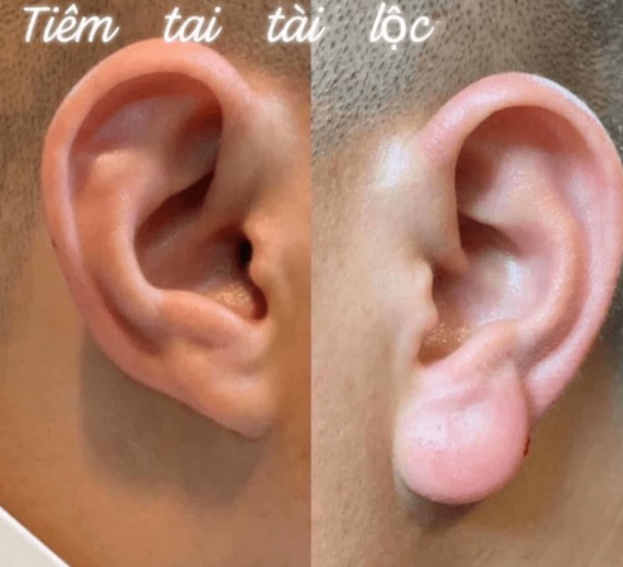 越南大叔喜欢把耳朵整得像弥勒佛那样，有着厚厚耳垂。（互联网）