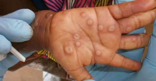 ◤猴痘来袭◢ 世卫警告：猴痘等疾病爆发 变得更加频繁