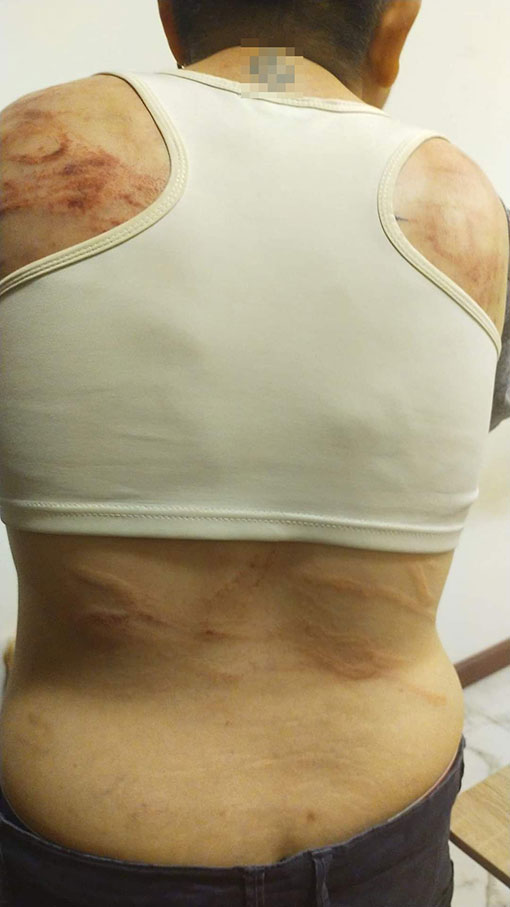 阿雯曾被殴打至遍体鳞伤。