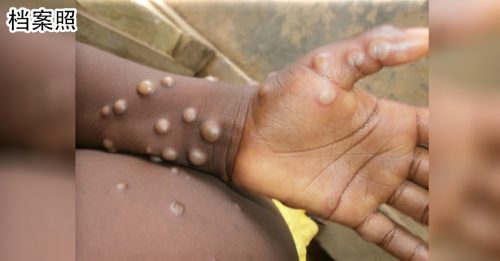 ◤猴痘来袭◢ 美国2500例猴痘 考虑进紧急状态