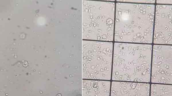 该名男子的精液在显微镜下“清清如水”，完全没有精虫在活动（左图），与有精虫的精液明显差异。
