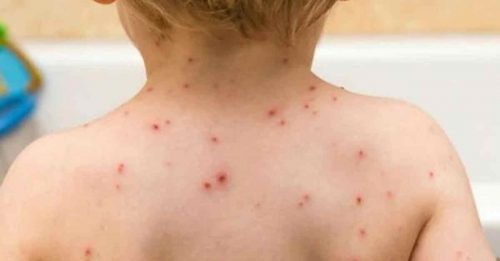 ◤猴痘来袭◢ 美国首次发现 幼童猴痘病例