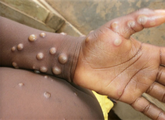 monkeypox 猴痘来袭