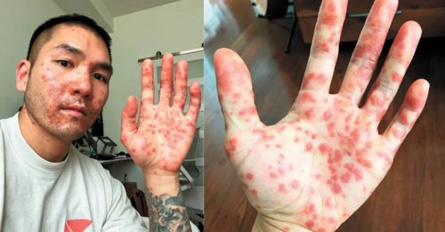 ◤猴痘来袭◢ 美华裔男患猴痘 多次被误诊致病情恶化险盲