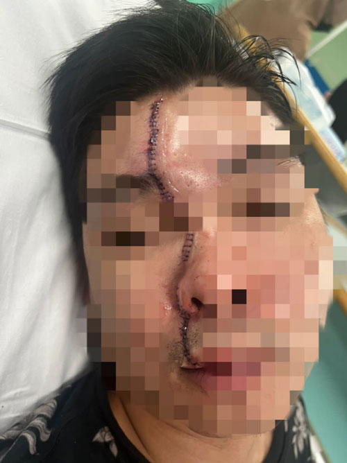 伤者脸部伤势严重，送院缝了120针，惨遭毁容。