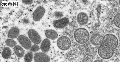 ◤猴痘来袭◢ 古巴发现首宗猴痘确诊病例