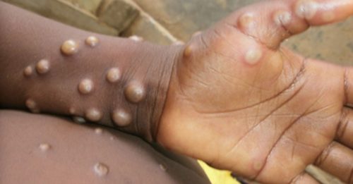 ◤猴痘来袭◢ 世卫：欧洲疫情趋缓 全球猴痘病例上周减21%