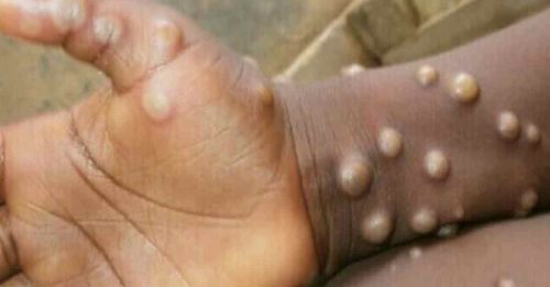 ◤猴痘来袭◢美国宣布猴痘 为公共卫生紧急事件