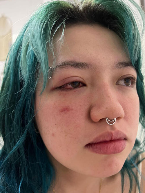 翁丽安脸部遭殴打，眼睛有红丝。（受访者提供） 
