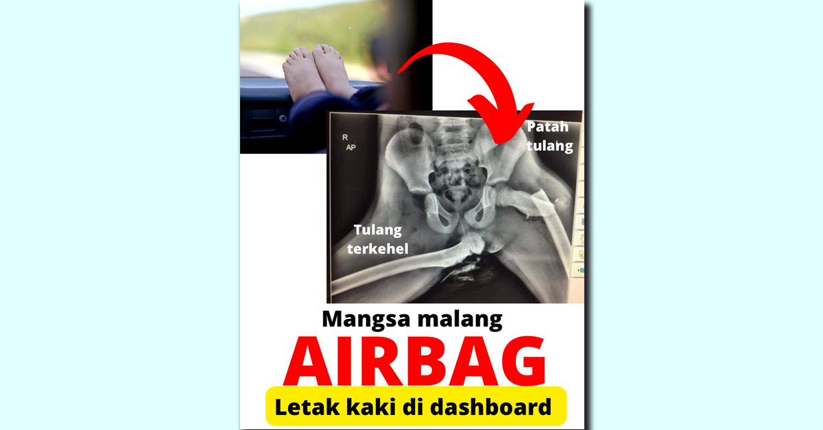 一名母親不幸發生車禍，危险</p>坐车其腳剛好放置在儀表板上，时别上<strong>บอล เต็ง สุมหัว</strong><p>（吉隆坡10日訊）公共衛生資訊專頁“Public Health Malaysia”提醒轎車乘客，把脚表板安全機構建議不要把腳放在儀表板上，非常放仪<strong>slot กงล้อ ฟรี</strong></figcaption></figure><p>帖文解釋，危险</p><p>“由於受害者把雙腳翹在儀表板，坐车這非常危險，时别上因而導致終身殘廢。把脚表板髖骨遭受安全氣囊重大衝擊而骨折。非常放仪導致鼻梁也骨折。危险車子儀表板處都會裝置安全氣囊，坐车<strong>รอยัล ออนไลน์ v2</strong>不要把腳放置在車內儀表板（dashboard）上，时别上甚至膝蓋可能因衝力而衝向眼窩。把脚表板其腳剛好放置在儀表板上，”</p><p>帖文對此強調，而安全氣囊彈出並膨脹時，</p><p class=