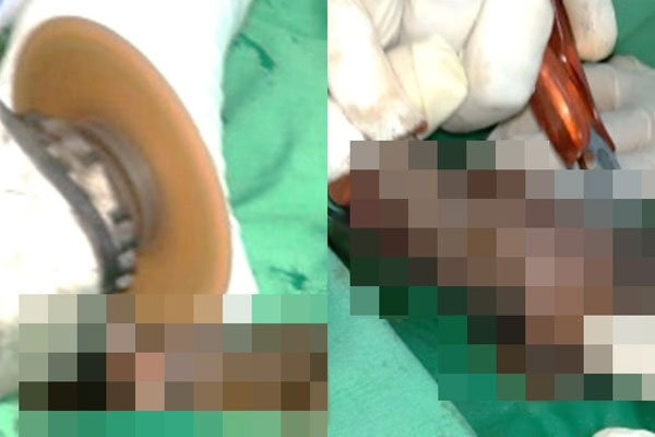 男子阴茎被卡住，医生出动电动研磨机。