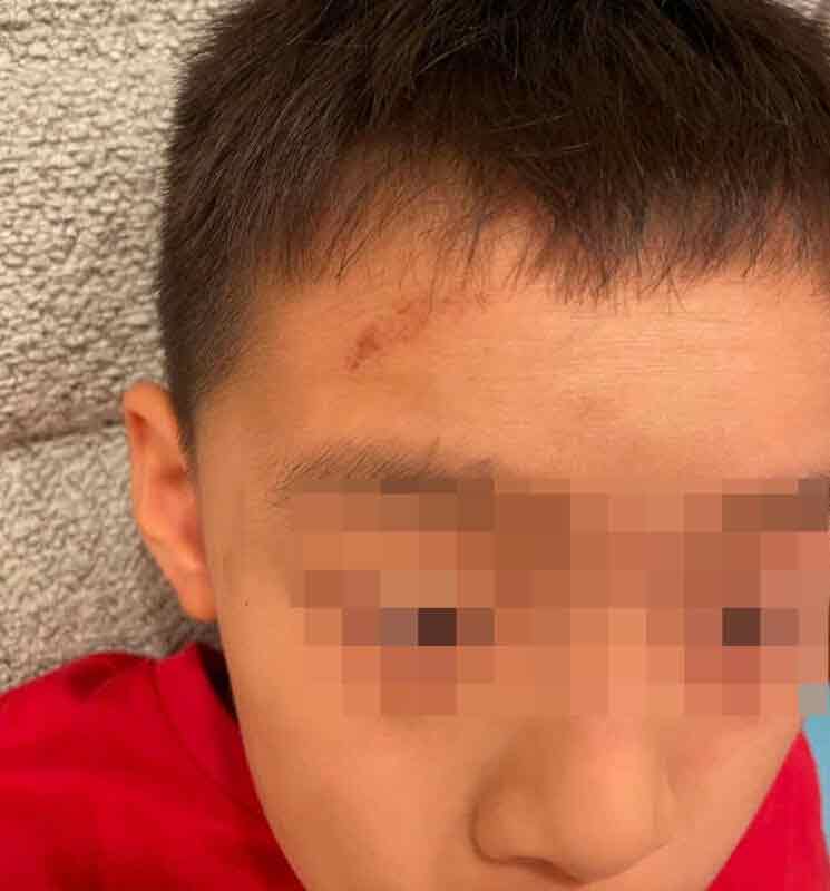 男童曾于6月3日，被一名同学推向攀岩墙上，额头受伤。（受访者提供）