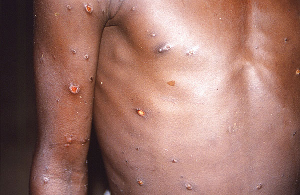 monkeypox hongkong canada 加拿大 猴痘