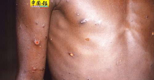 消息：香港现首例猴痘输入病例