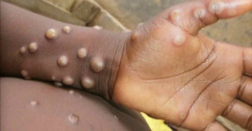 ◤猴痘来袭◢全球猴痘确诊破5万 欧美热区传播趋缓