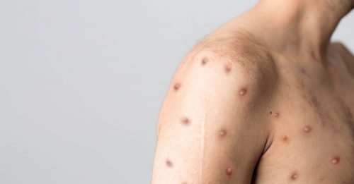 ◤猴痘来袭◢ 越南首例猴痘 女患者曾到迪拜
