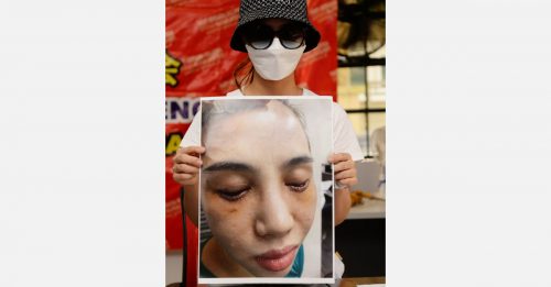 “住家式”美容院整容 越南女割眼袋 变熊猫眼