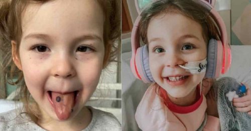 3岁女童舌头长黑点 竟是致命疾病征兆