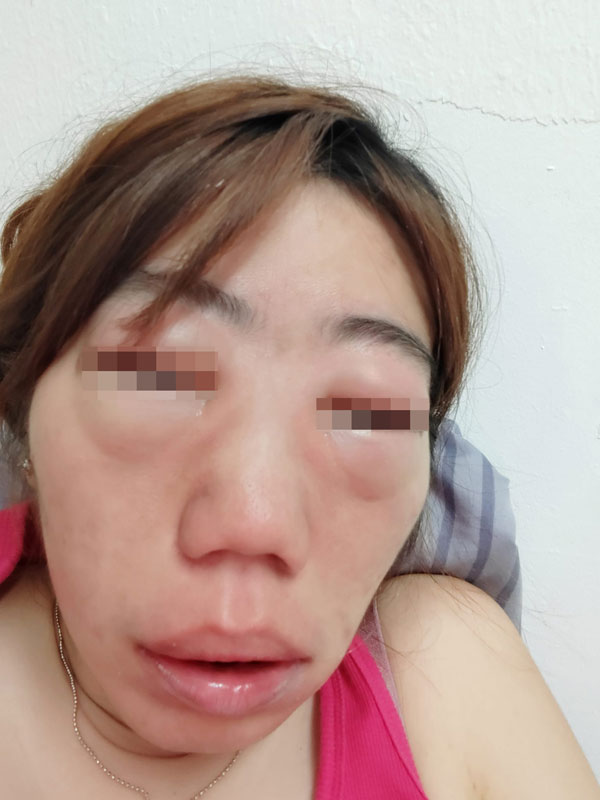 杨小姐服药后3小时脸部肿到惨不忍睹。