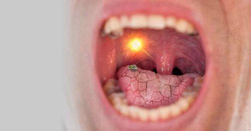 舌头溃疡3年 以为火气大 空姐确诊罕癌 舌头切剩一半
