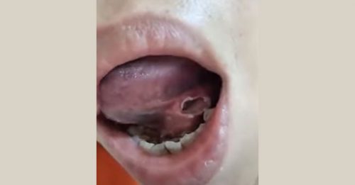 女子拔牙舌底被钻破大洞 牙医竟回答“破皮而已”